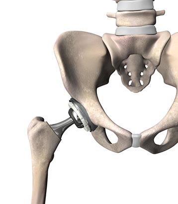 Illustration of replaced hip parts using Stryker Mako at Upland Hills Health