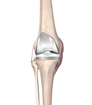 Illustration of replaced knee using Stryker Mako at Upland Hills Health