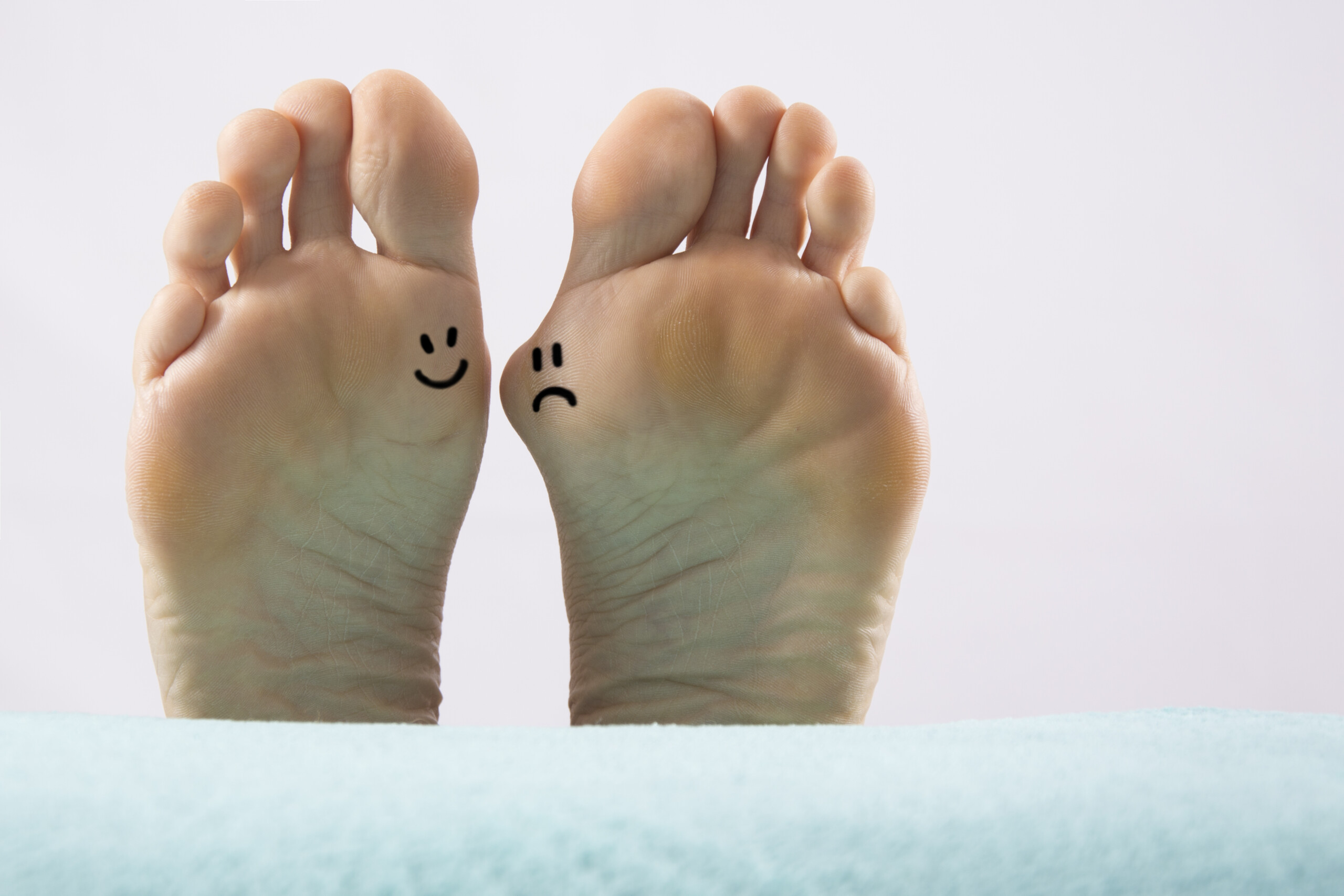 Bunion photo bottoms of feet